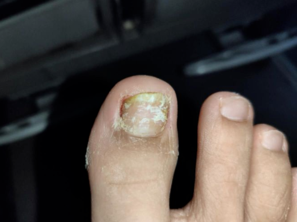 美甲灰指甲_美甲液灰指甲_美甲店灰指甲