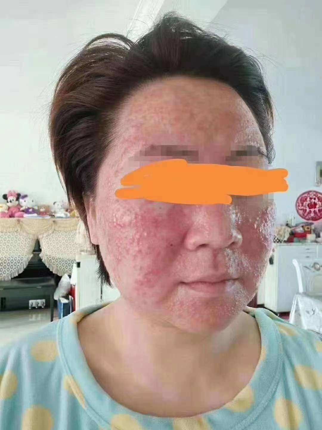 护肤激素产品有哪些成分_安利护肤品有激素吗_护肤激素安利品有哪些