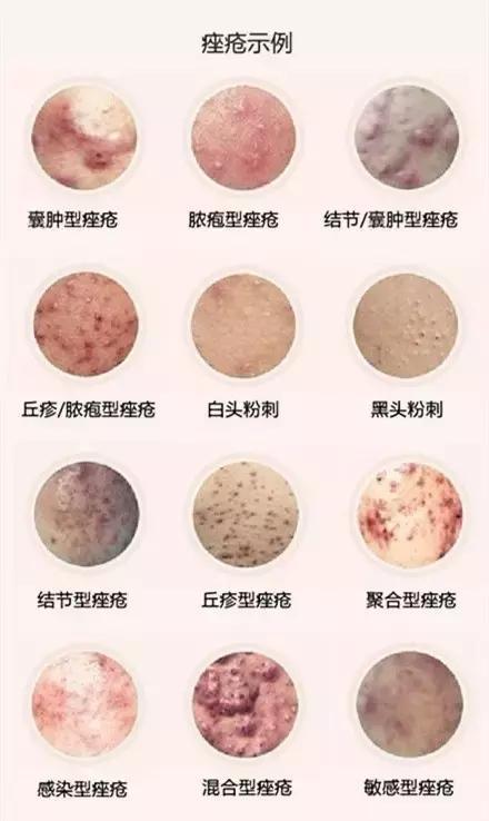 调理毛孔的护肤品_雅漾祛油细致毛孔调理露怎么样_毛孔去油
