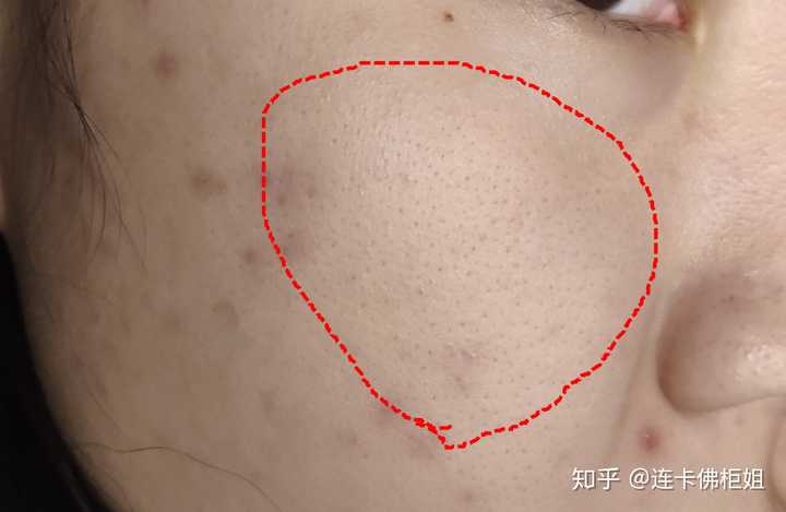 毛孔去油_雅漾祛油细致毛孔调理露怎么样_调理毛孔的护肤品