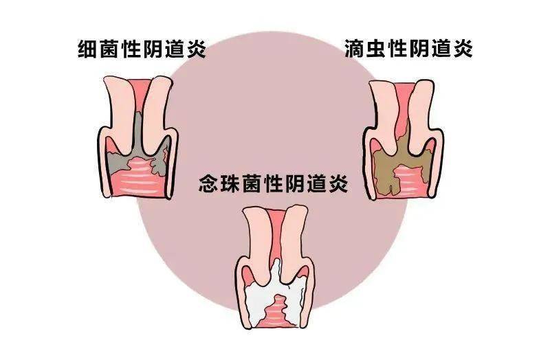 白带黄稠平时怎么调理_白带黄稠平时怎么调理_白带黄稠平时怎么调理