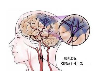 血管脑健康心得感悟_心脑血管健康_血管脑健康心得怎么写