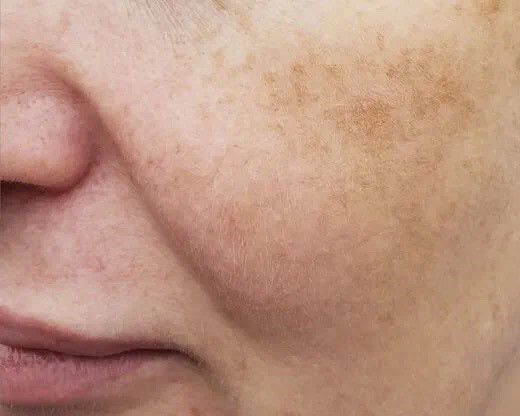 脸上有斑食疗方法_脸上长斑怎么调理食疗_脸上的斑食疗可以祛除