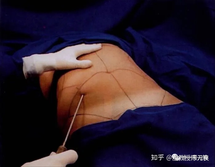 吸脂手术北京哪个医院最好_手术吸脂北京好做吗多少钱_北京吸脂手术谁做的好